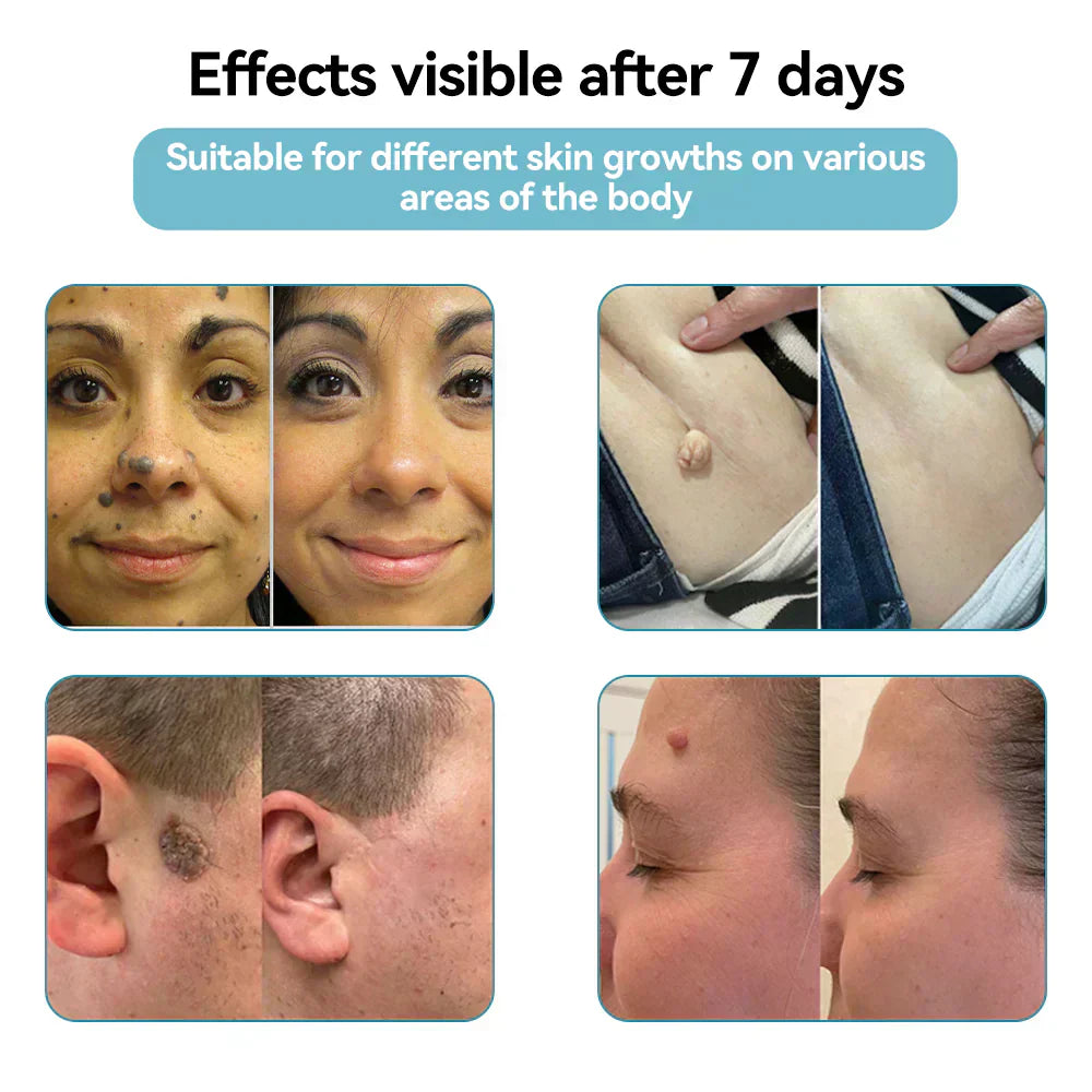 All-in-One CO₂ Laser Eraser Pen | Removes Moles, Warts, Skin Flaws & Pigmentation